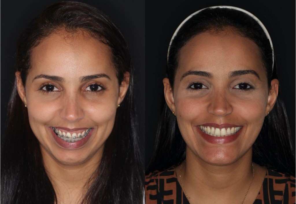 Cirurgia ortognática corrige problemas funcionais e traz autoestima e qualidade de vida para os